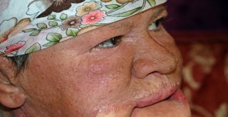 Çenesinde Çıkan Sivilceyi Önemsemedi, Hayatı Karardı