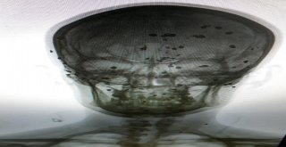 (Özel) Başındaki 80 Saçmayla 12 Yıldır Yaşıyor