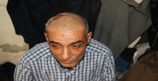 (Özel) 20 Yıldır Kafasında Çivilerle Yaşıyor