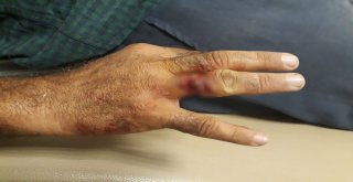 Elini İş Makinesine Kaptıran İşçinin Yüzüğü Parmağına Saplandı