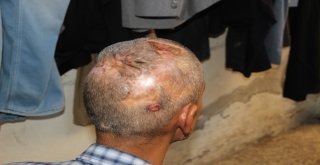 (Özel) 20 Yıldır Kafasında Çivilerle Yaşıyor