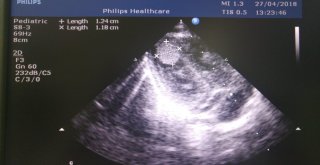 Kalbinde 9 Adet Tümör İle Doğan Bebek Sağlığına Kavuşuyor