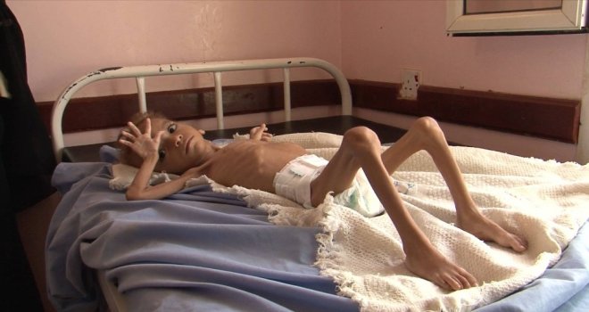 Yemende Savaşın Çocukları Açlıkla Mücadele Ediyor